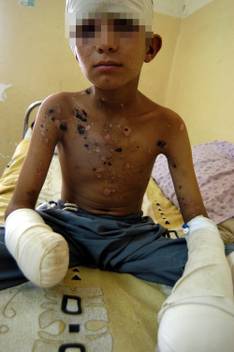 Ahmed Kamel, 12-year old Iraqi, victim of US cluster bomb